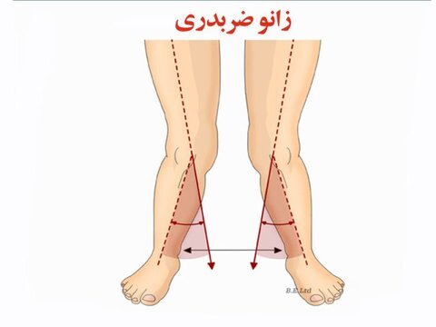 ناهنجاری زانوی ضربدری و حرکات اصلاحی آن