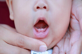 تاثیر چاقی و لاغری بر پوسیدگی‌های شدید دندانی در کودکان