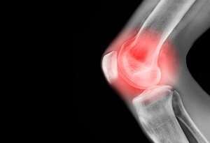 کاربرد تکنولوژی های پیشرفته در جهت ترمیم مهندسی بافت غضروف