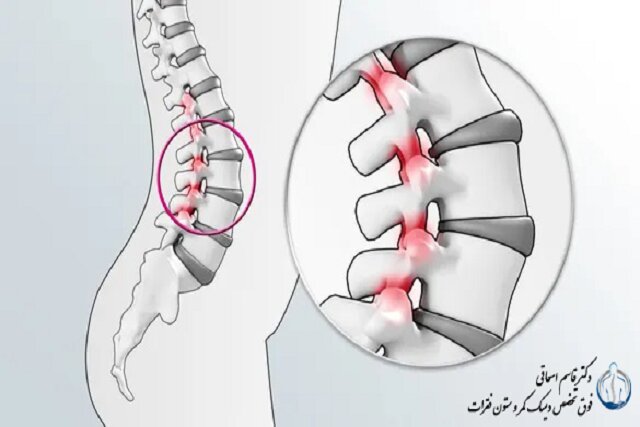 دیسک کمر چیست؟ 