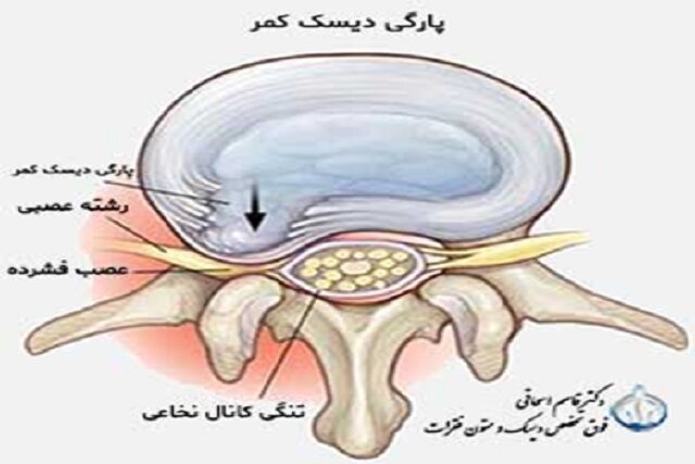 فتق یا پارگی دیسک کمر چیست؟