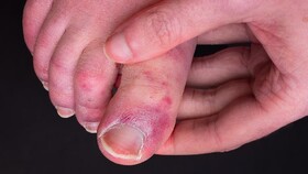 چرا برخی افراد به عارضه "انگشت پای کوویدی" مبتلا می شوند