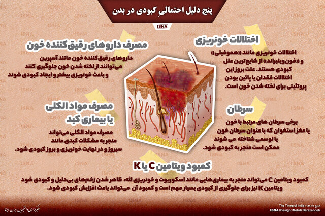 اینفوگرافیک / پنج دلیل احتمالیِ کبودی در بدن