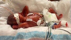 رکوردزنی نارس‌ترین نوزاد جهان در زنده ماندن