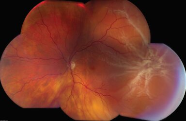 سرمایهگذاری "وزارت دفاع آمریکا" برای پژوهش درباره یک بیماری نادر چشمی