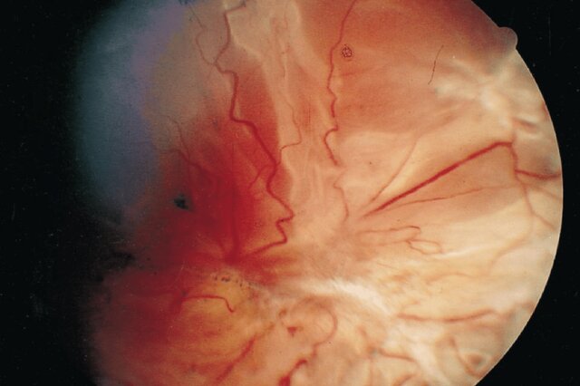 سرمایهگذاری "وزارت دفاع آمریکا" برای پژوهش درباره یک بیماری نادر چشمی سرمایهگذاری "وزارت دفاع آمریکا" برای پژوهش درباره یک بیماری نادر چشمی