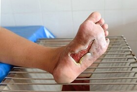 مراقبت‌های طلایی برای درمان زخم پای دیابتی