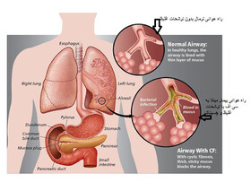 سی اف، پر از رنج و هزینه اما ناشناخته