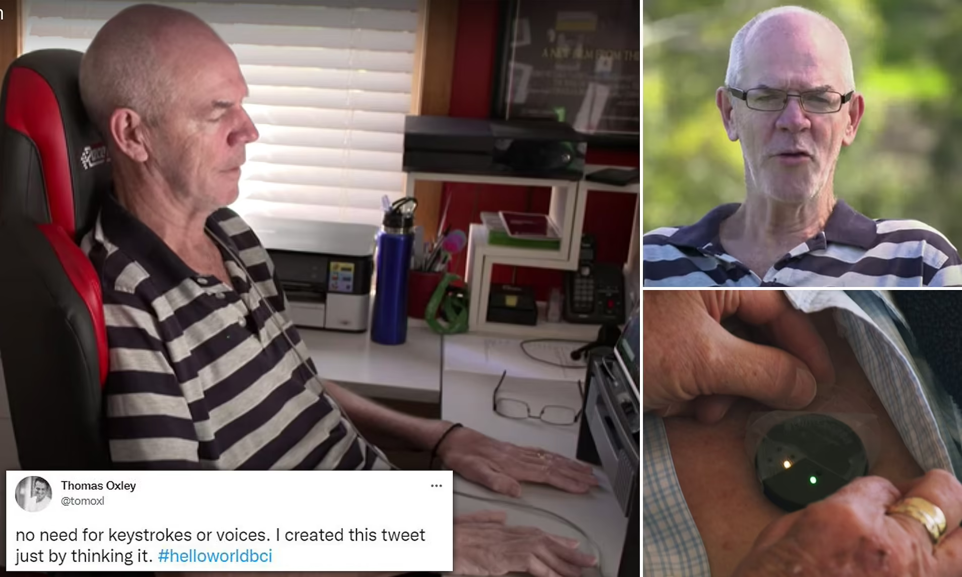 ارسال نخستین توییت با تراشه مغزی توسط یک مرد دچار فلج مغزی