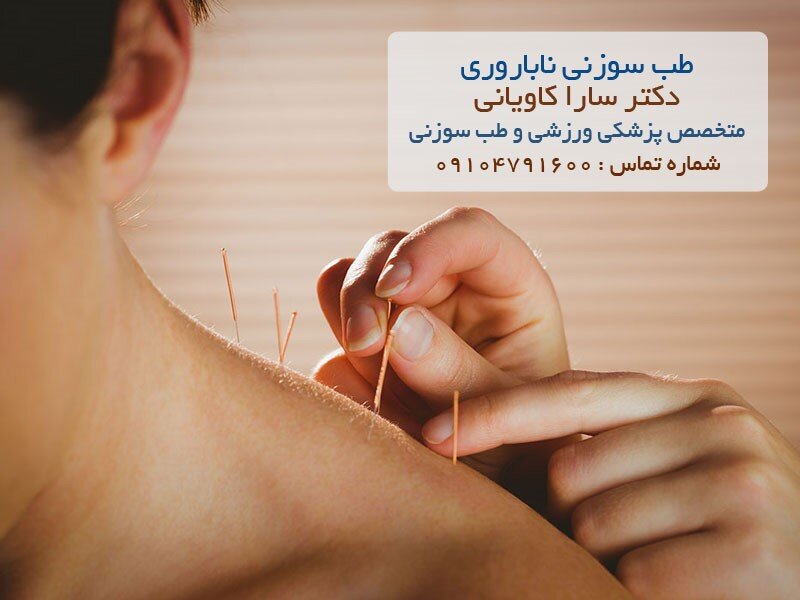 طب سوزنی ناباروری