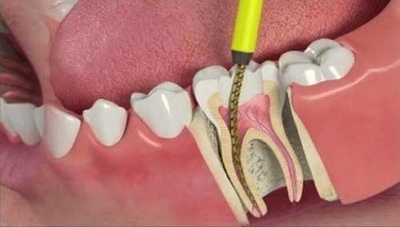 مرحله به مرحله عصب کشی تا پرکردن دندان