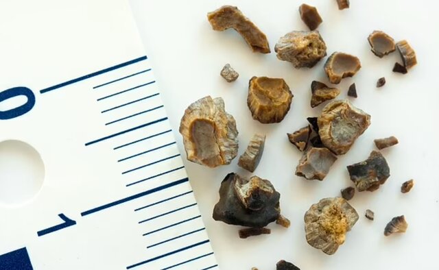 تغییرات جوی احتمال ابتلا به سنگ کلیه را افزایش میدهد!