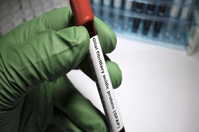 نشانگرهای آسیب مغزی مبتلایان به کووید -19 بیشتر از مبتلایان به آلزایمر