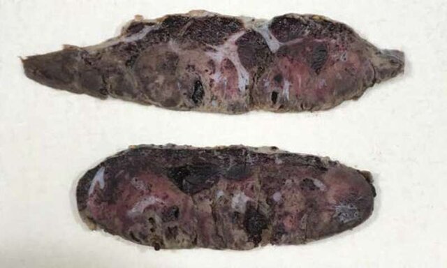 آسیب به جفت عامل مردهزایی در زنان مبتلا به کووید-۱۹