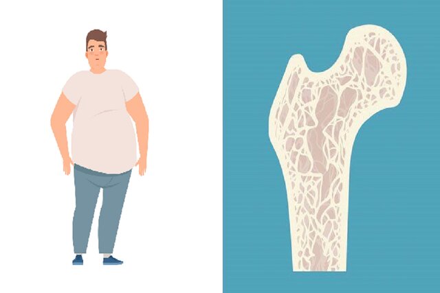 مردان چاق بیشتر در معرض خطر ابتلا به پوکی استخوان هستند
