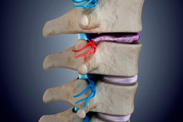 درمان کم هزینه، آسان و بی دردسر فتق دیسک کمر با طب فیزیکی
