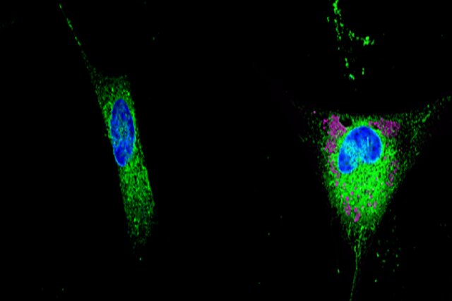 نقش مهم لیپیدها در بروز آلزایمر
