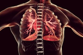 ارتباط کووید طولانی مدت با بیماری مجاری هوایی کوچک ریه‌ها