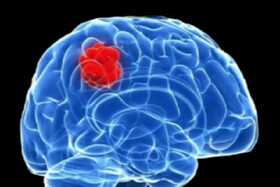 درمان جدیدی که سلول‌های سرطانی مغز را فریب می‌دهد