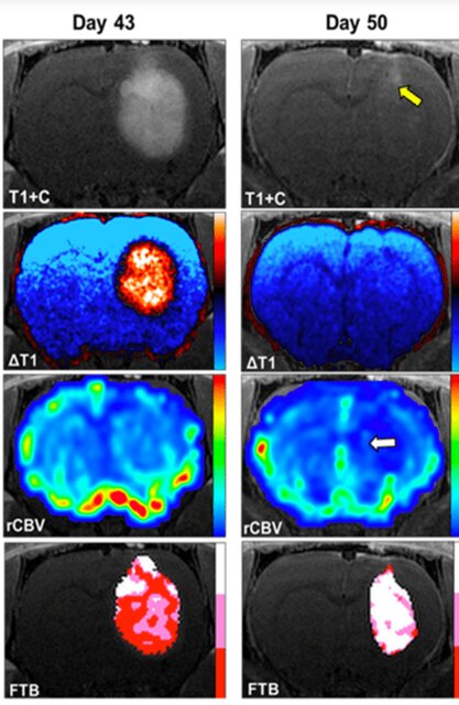 درمان جدیدی که سلولهای سرطانی مغز را فریب میدهد