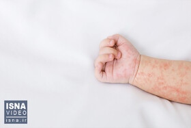 ویدئو / افزایش موارد سرخک در جهان؛ سازمان ملل هشدار داد