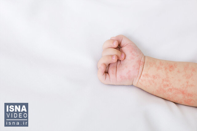 عکس از آرشیو است مورد مشکوکی از ابتلا به سرخک در قوچان مشاهده نشده است