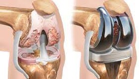 ورکشاپ تخصصی «آرتروپلاستی» برگزار می شود