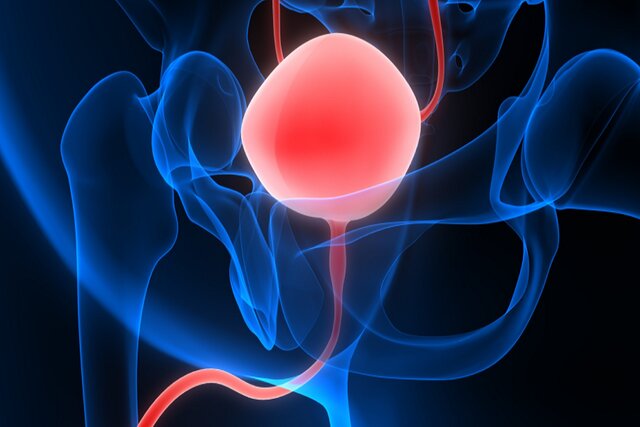 ایمنیدرمانی پس از جراحی، از عود کردن سرطان مثانه جلوگیری میکند ایمنیدرمانی پس از جراحی، از عود کردن سرطان مثانه جلوگیری میکند