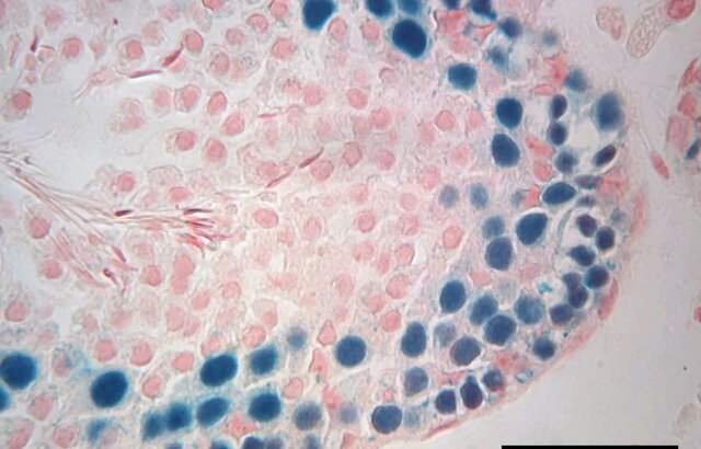 گامی مهم در جهت حفظ توان باروری مردان مبتلا به سرطان
