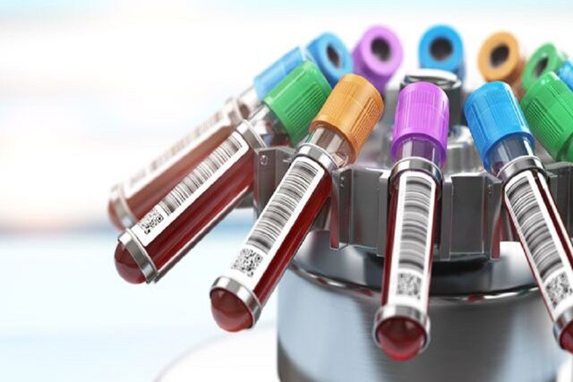 انجام آزمایشی برای شناسایی یک سرطان خون شایع انجام آزمایشی برای شناسایی یک سرطان خون شایع