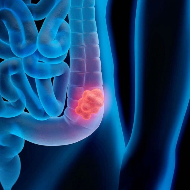 علائم سرطان روده چیست؟ علائم سرطان روده چیست؟