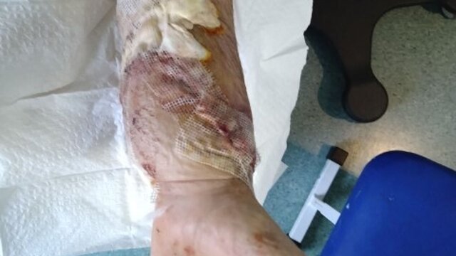 اولین پیوند هر دو دست در جهان در یک فرد مبتلا به اسکلرودرمی