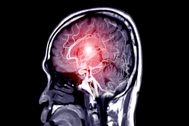 نمایش التهاب مغزی برای اولین بار با استفاده از نوعی جدیدی از ام.آر.آی