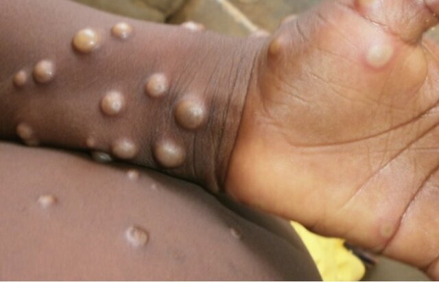 شناسایی یک مورد مشکوک به آبله میمونی در قزوین