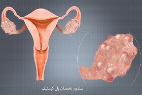کیست‌های تخمدان، مشکلی شایع که با آگاهی قابل کنترل است