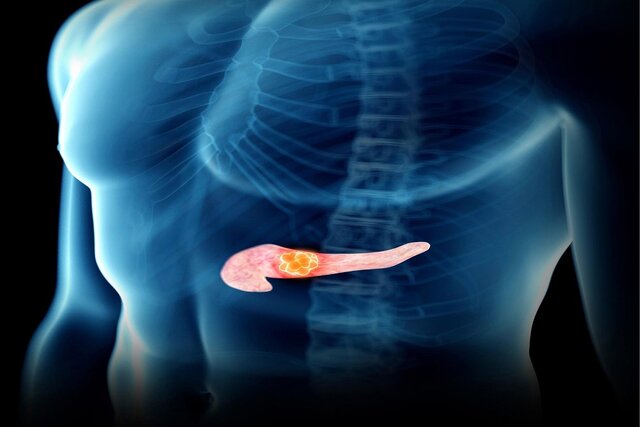 جلوگیری از گسترش سرطان لوزالمعده با یک پروتئین جلوگیری از گسترش سرطان لوزالمعده با یک پروتئین