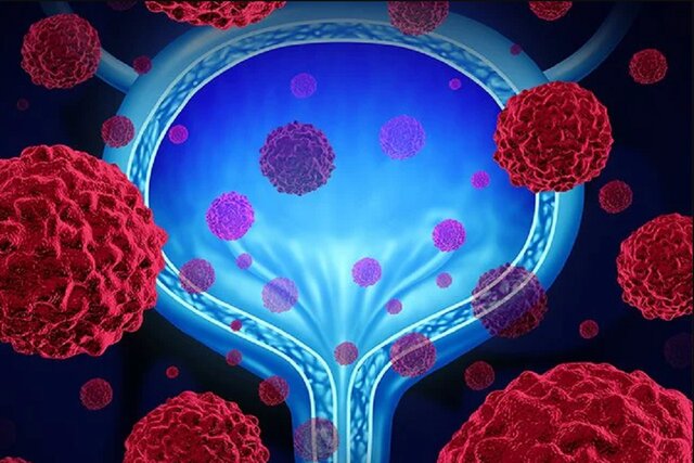 عکس خبر تزیینی است. شایعترین علامت سرطان مثانه که سیگاریها باید جدی بگیرند