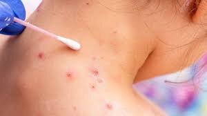 هرآنچه در مورد آبله میمونی باید بدانیم