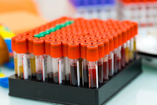 پیشبینی زودهنگام ابتلا به دیابت با یک آزمایش خون ساده پیشبینی زودهنگام ابتلا به دیابت با یک آزمایش خون ساده