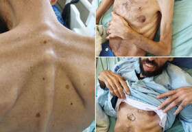 انتشار تصاویر اسیر فلسطینی پس از ۶ ماه اعتصاب غذا/اتحادیه اروپا: شوکه کننده بود