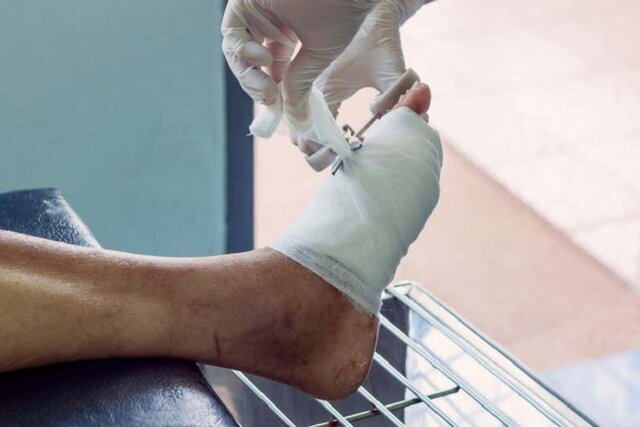 درمان زخمهای مزمن دیابت با ترکیب به دستآمده از یک درخت درمان زخمهای مزمن دیابت با ترکیب به دستآمده از یک درخت