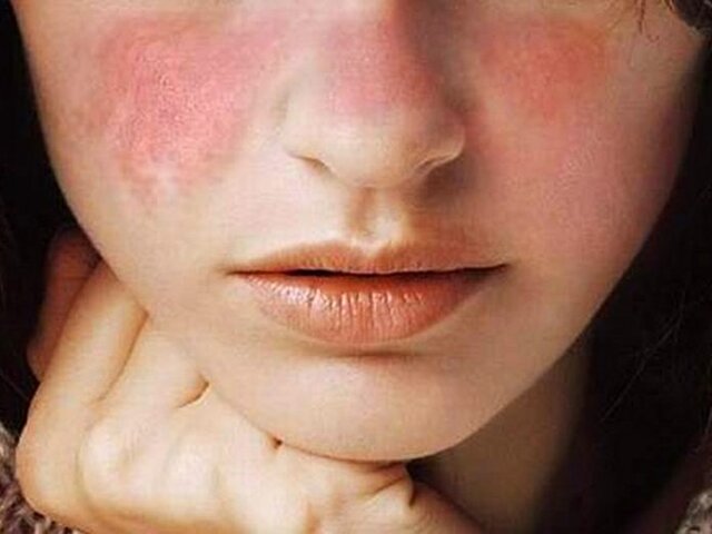 عکس تزیینی است. همه چیز درباره یک بیماری هزارچهره که ۹۰ درصد مبتلایانش زنان هستند