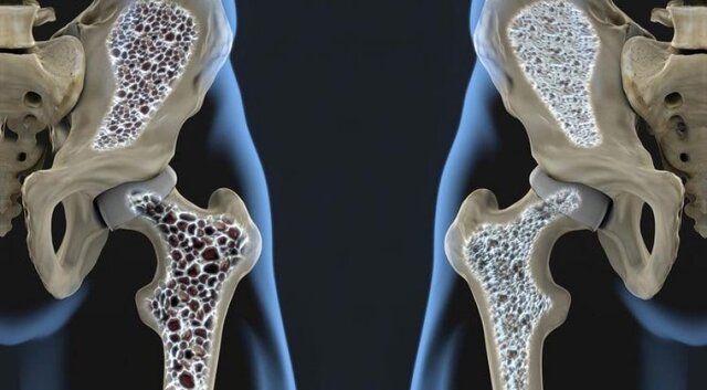 عکس تزیینی است. پوکی استخوان از علل خمیدگی بدن در دوران سالمندی است