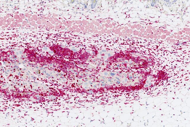 ابداع واکسن سرطان با استفاده از سلولهای زامبی!