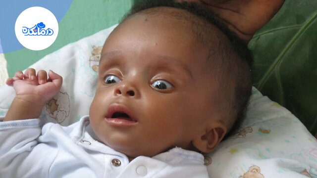 هیدروسفالی چیست و علائم و درمان آن کدام است؟