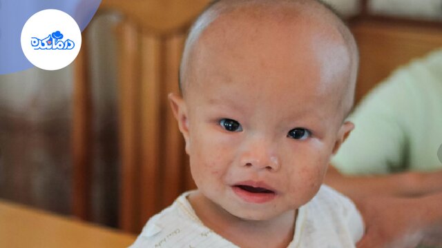 هیدروسفالی چیست و علائم و درمان آن کدام است؟