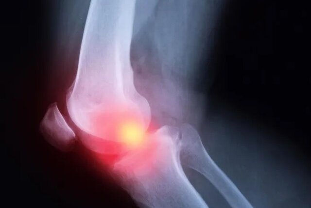 عکس تزیینی است. آرتروز، شایعترین بیماری مزمن مفاصل