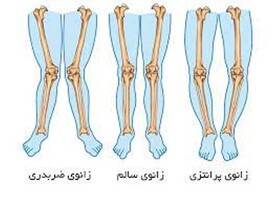 درمان ورزشی پای پرانتزی بزرگسالان!