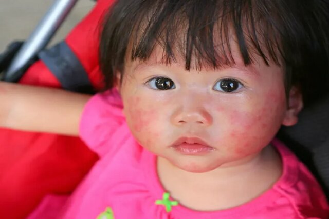 عکس تزئینی است  اگزما؛ شایعترین بیماری پوستی کودکان با ریشه ژنتیکی و تشدید عوامل محیطی