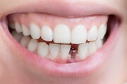هشدار یک متخصص ایمپلنت درباره تاثیر سیگار بر شکست درمان